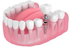 Illustration of a single dental implant