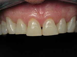 Before Natural Veneers Treatment.