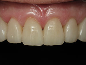 After receiving natural veneers at Dale Greer DDS, Inc