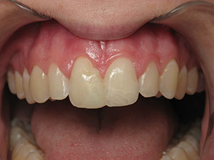 Before Direct Resin Veneers treatment