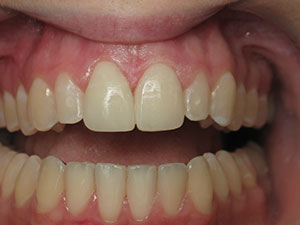 After Direct Resin Veneers in provided by North Dallas Dentist