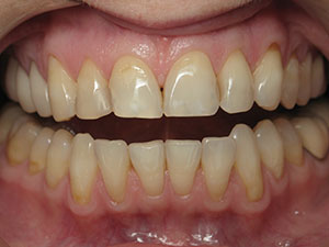 Before Esthetic Crowns Treatment