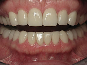 North Dallas Natural Esthetic Crowns