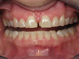Before full mouth esthetic crowns treatment