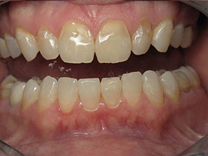 Before receiving porcelain veneers