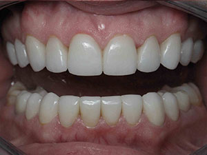 After receiving porcelain veneers in North dallas