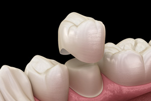 Illustration showing how a dental crown works 