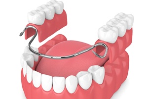 Digital model of partial denture