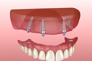 Model of implant supported upper denture