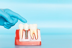 Dental implant treatment is an investment in yourself