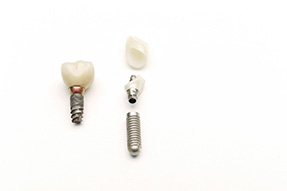 different parts of your dental implants will affect their cost