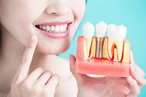 a model of dental implants