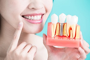a model of dental implants