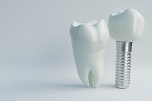 a model of dental implants