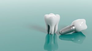 two examples of dental implants