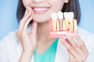 woman holding diagram of dental implants