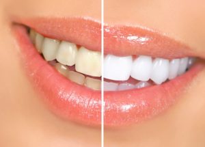 before and after of teeth whitening