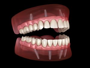 Model of upper and lower All-On-4 dental implants